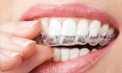 invisalign